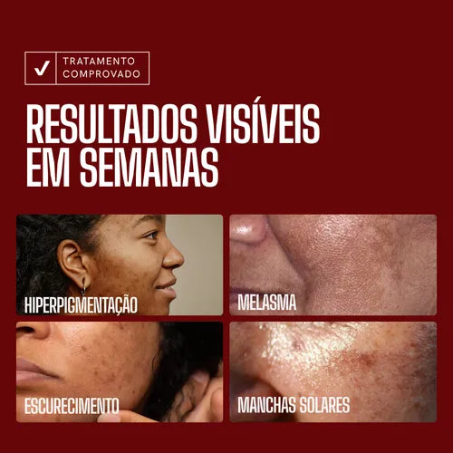 Sérum Envy Skin 30ml – Clareador com Ácido Tranexâmico para Manchas e Melasma